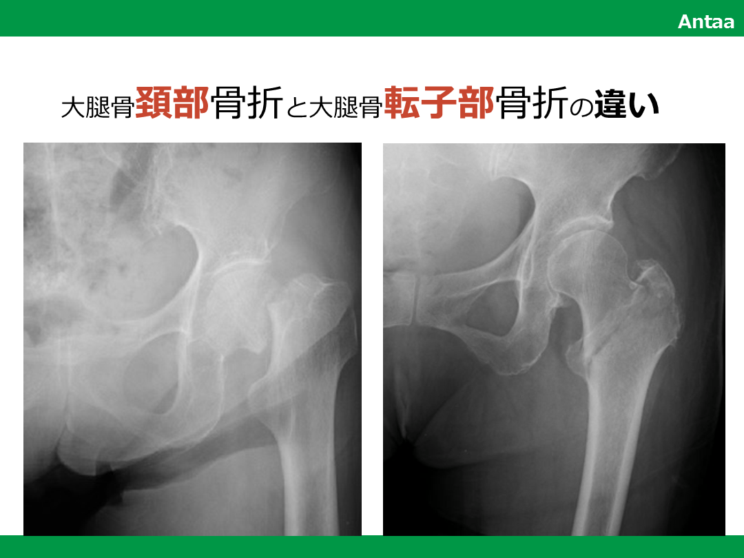 大腿骨頚部骨折と大腿骨転子部骨折/レントゲン, 手術の違い L001.png