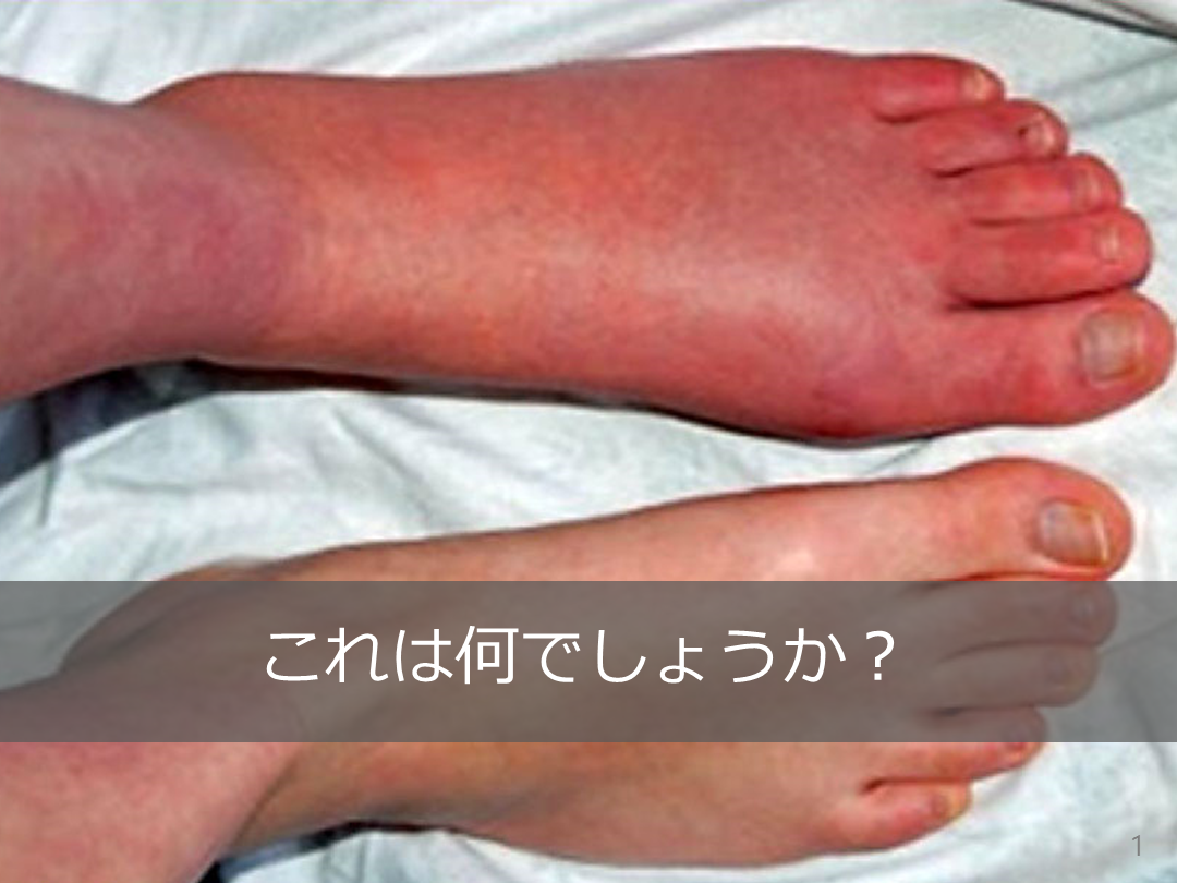【MKSAP】簡単解説 DVT L001.png