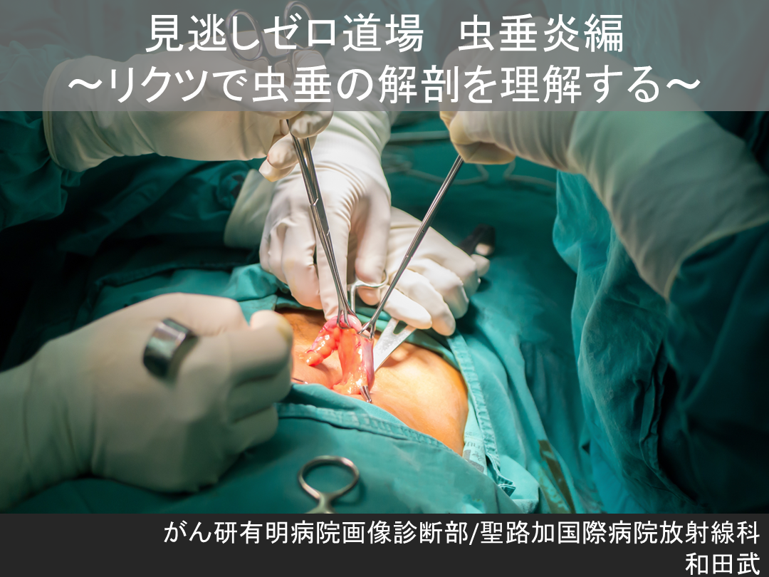 見逃しゼロ道場!!虫垂炎!! L001.png
